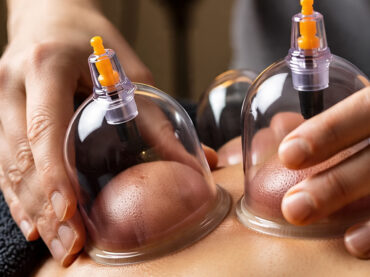 Dry Cupping Therapy