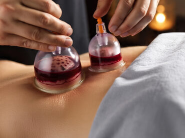 Wet Cupping Therapy