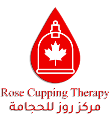 cupping therapy