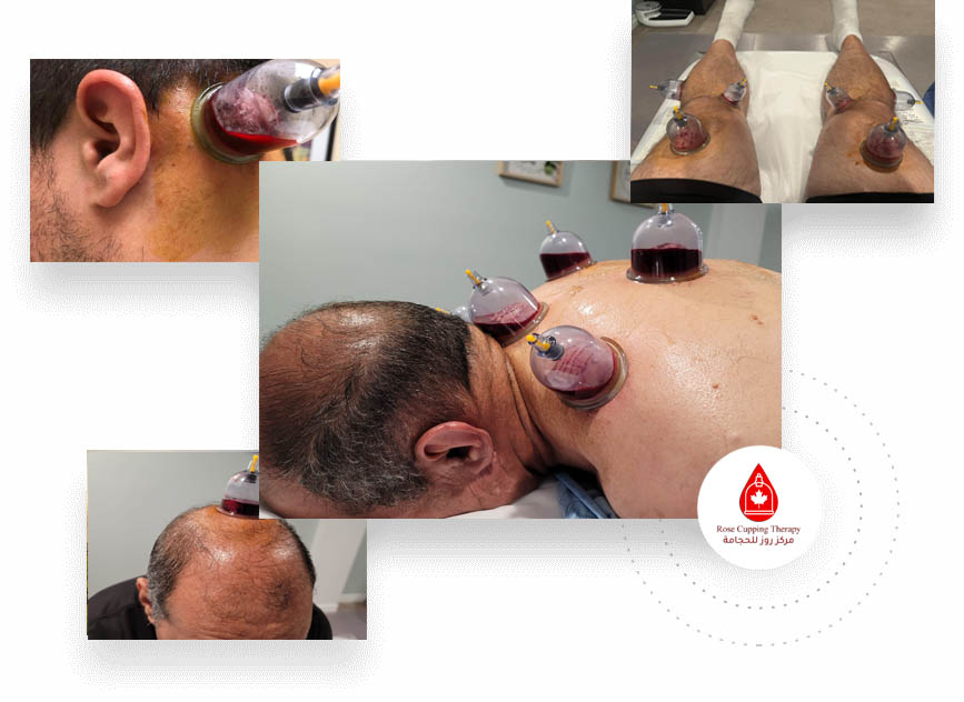 Dry Cupping Therapy