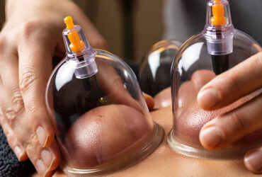 Dry Cupping Therapy