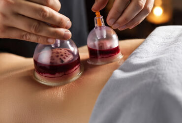 Wet Cupping Therapy