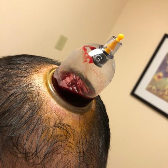 Cupping for migraines