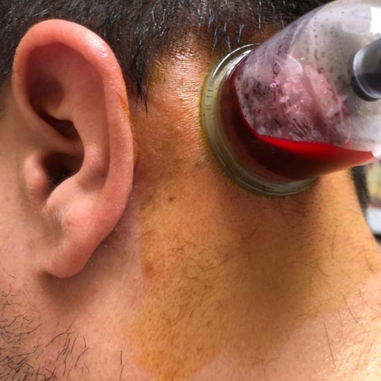 Cupping for migraines