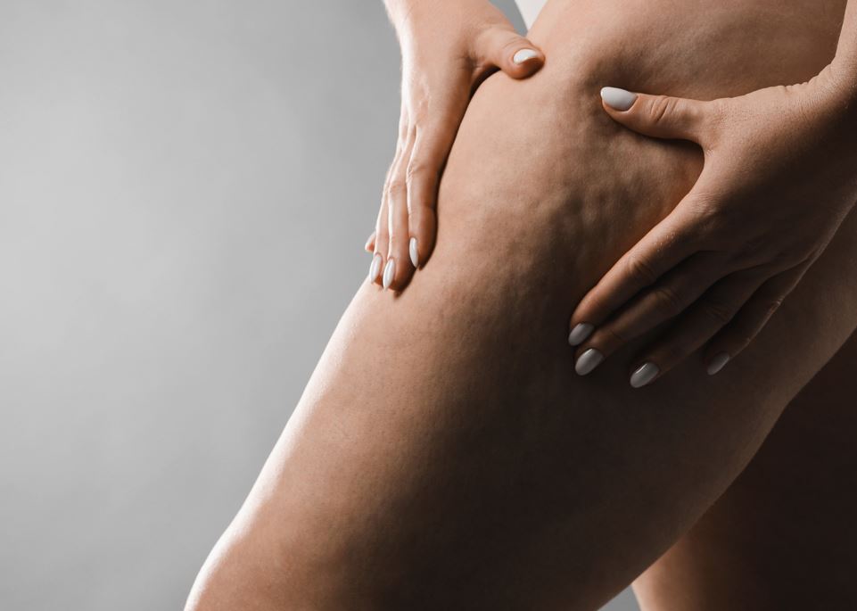 Cupping for cellulite